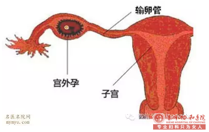 赤峰宁城县宫外孕疾病能够预防吗？