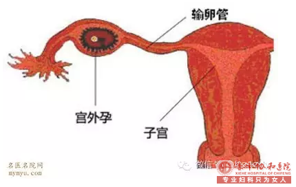 赤峰宁城县宫外孕疾病能够预防吗?